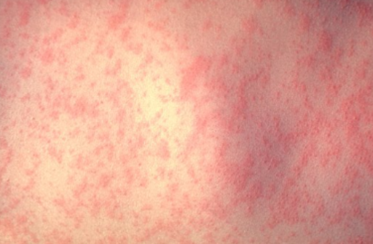 Rising of Measles Cases